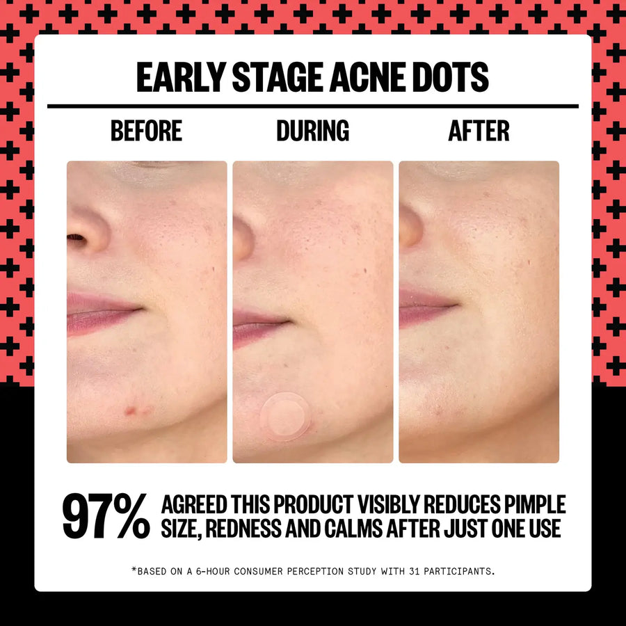 Early Stage Acne Dots