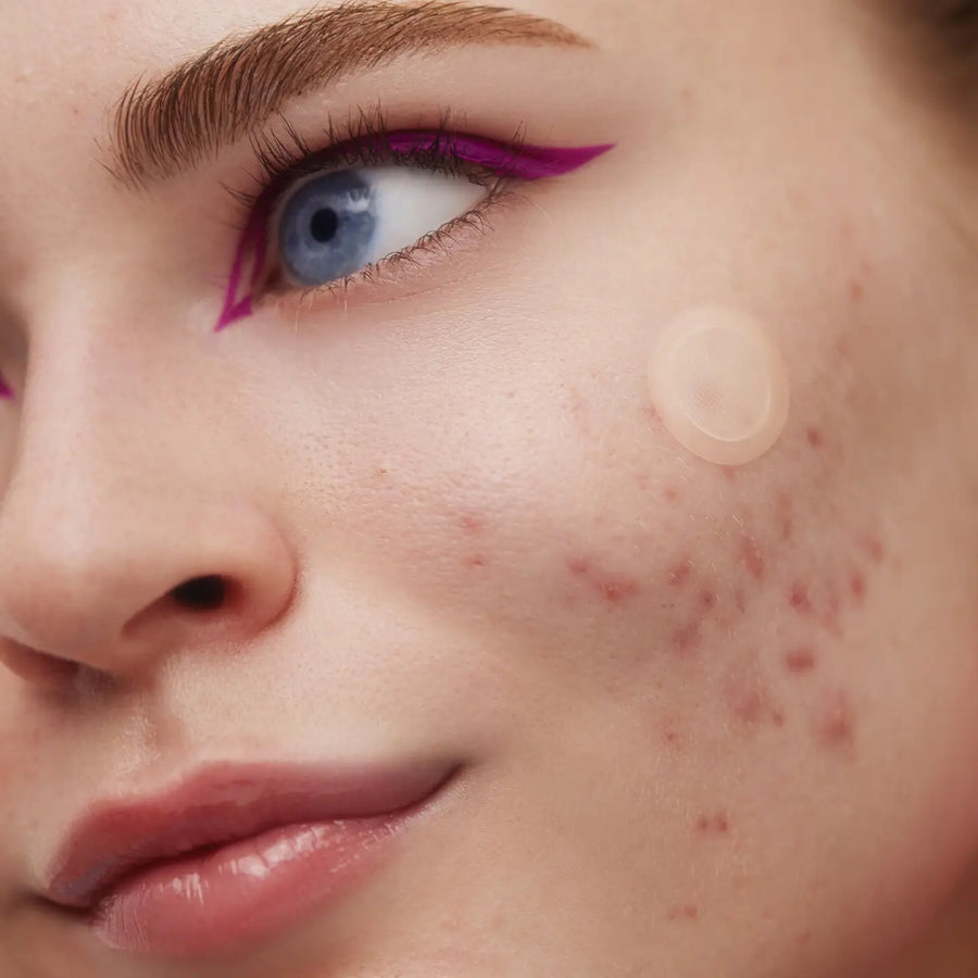 Early Stage Acne Dots