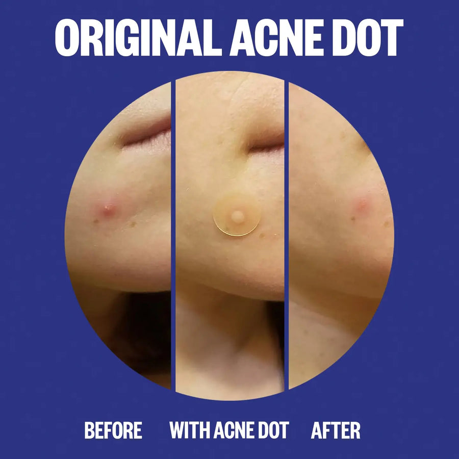 Acne Day & Night Duo